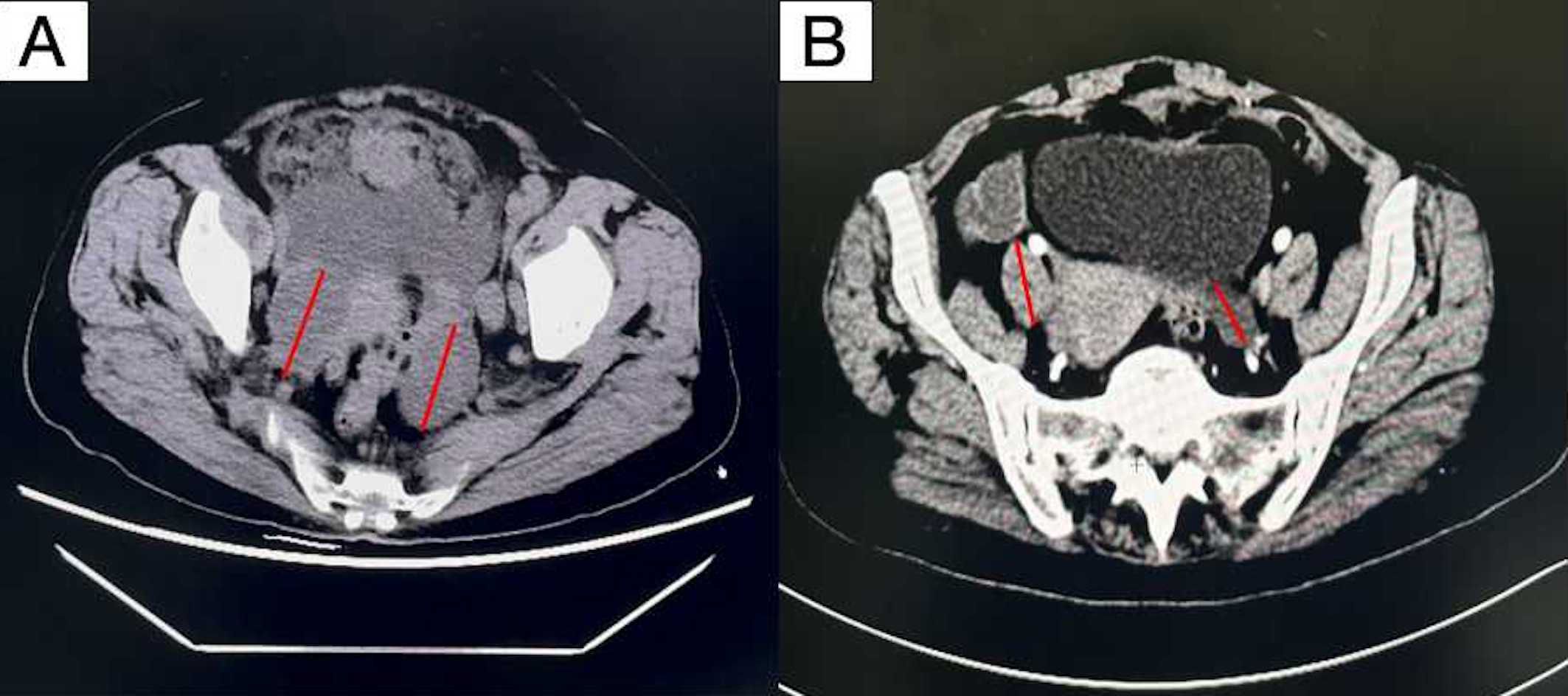 CT scans in transverse view. Panel A displays a scan with red lines indicating specific areas within the pelvic region. Panel B shows a similar scan with red lines highlighting different areas.