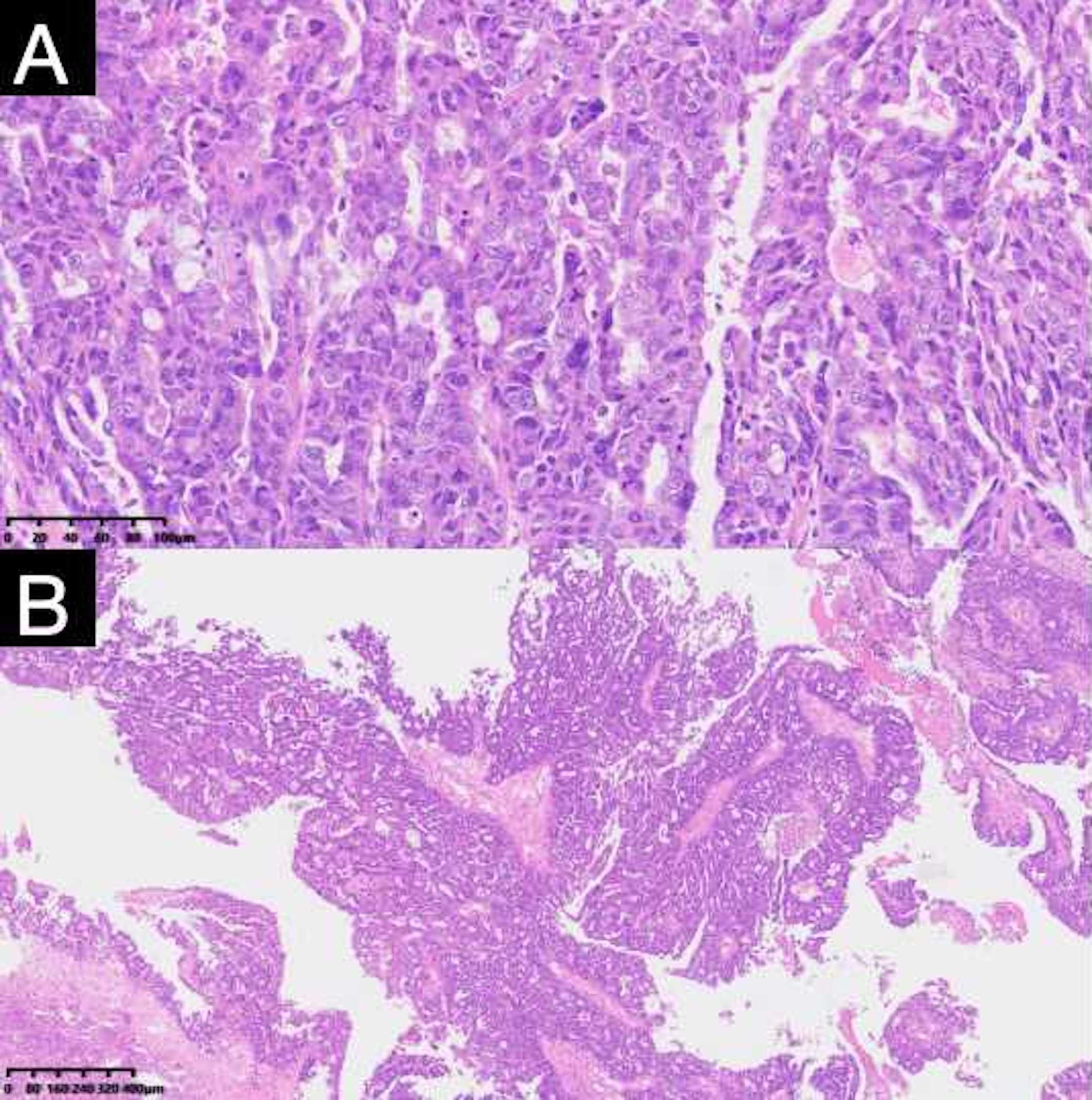 Panel A shows a microscopic view of tightly packed cells with a high nucleus-to-cytoplasm ratio, characteristic of malignancy. Panel B presents a lower magnification view, illustrating an irregular, glandular pattern with abundant fibrous stroma, consistent with adenocarcinoma. Both images are stained for histological examination.