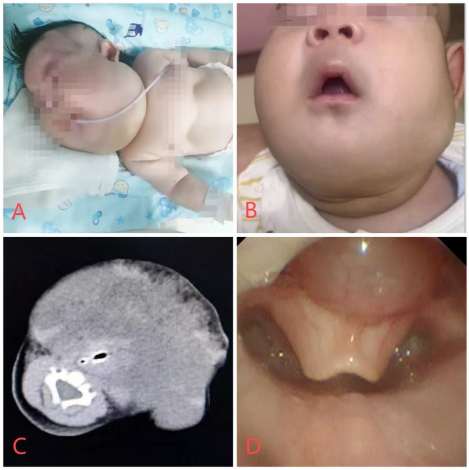 Four-panel medical image: Panel A shows an infant with visible neck swelling. Panel B displays a close-up of the infant's face and neck, emphasizing the swelling. Panel C is a side-view X-ray of the neck, highlighting internal structures. Panel D shows an endoscopic view of the airway.
