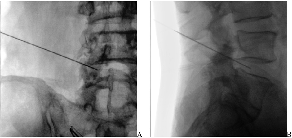 Fluoroscopic images labeled A and B show the needle placement technique for a lumbar spine procedure, likely a transforaminal epidural injection or discography. Image A provides an anteroposterior view, displaying the needle advancing toward the intervertebral foramen on one side of the lumbar spine, with vertebral pedicles and disc spaces visible for anatomical orientation. Image B shows a lateral view of the same region, demonstrating the needle’s trajectory passing through the soft tissues and aligning with the target near the intervertebral disc, confirming appropriate depth and position. Both views are used together to ensure accurate and safe placement of the needle.