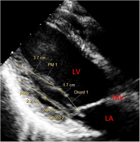 Ultrasound image of the heart showing measurements and structures labeled as left ventricle (LV), mitral valve (MV), and left atrium (LA). Measurements indicate distances of 3.7 cm, 2.2 cm, and 1.7 cm for different regions, with points marked as PM1, PM2, Chord 1, and Chord 2.