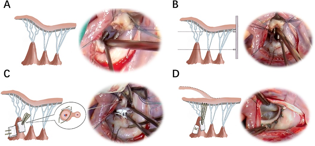 Four-panel image illustrating a surgical procedure with illustrations and intraoperative photos. (A) Shows tissue structure and alignment with a corresponding surgical view. (B) Includes alignment against a vertical line with a surgical view. (C) Depicts tissue adjustment with a detailed inset of a cross-section and surgical image. (D) Shows a repaired structure with reinforcing sutures and a surgical view. PM, papillary muscle.
