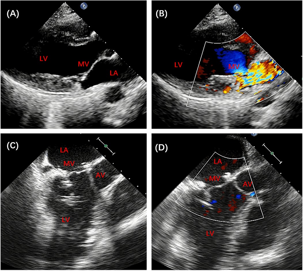 Four ultrasound images of the heart labeled (A–D). \n\nA: Shows the left ventricle (LV), mitral valve (MV), and left atrium (LA).\n\nB: Similar view with color Doppler indicating blood flow through the MV.\n\nC: Displays the LA, MV, aortic valve (AV), and LV.\n\nD: Similar view to C with color Doppler showing blood flow patterns.