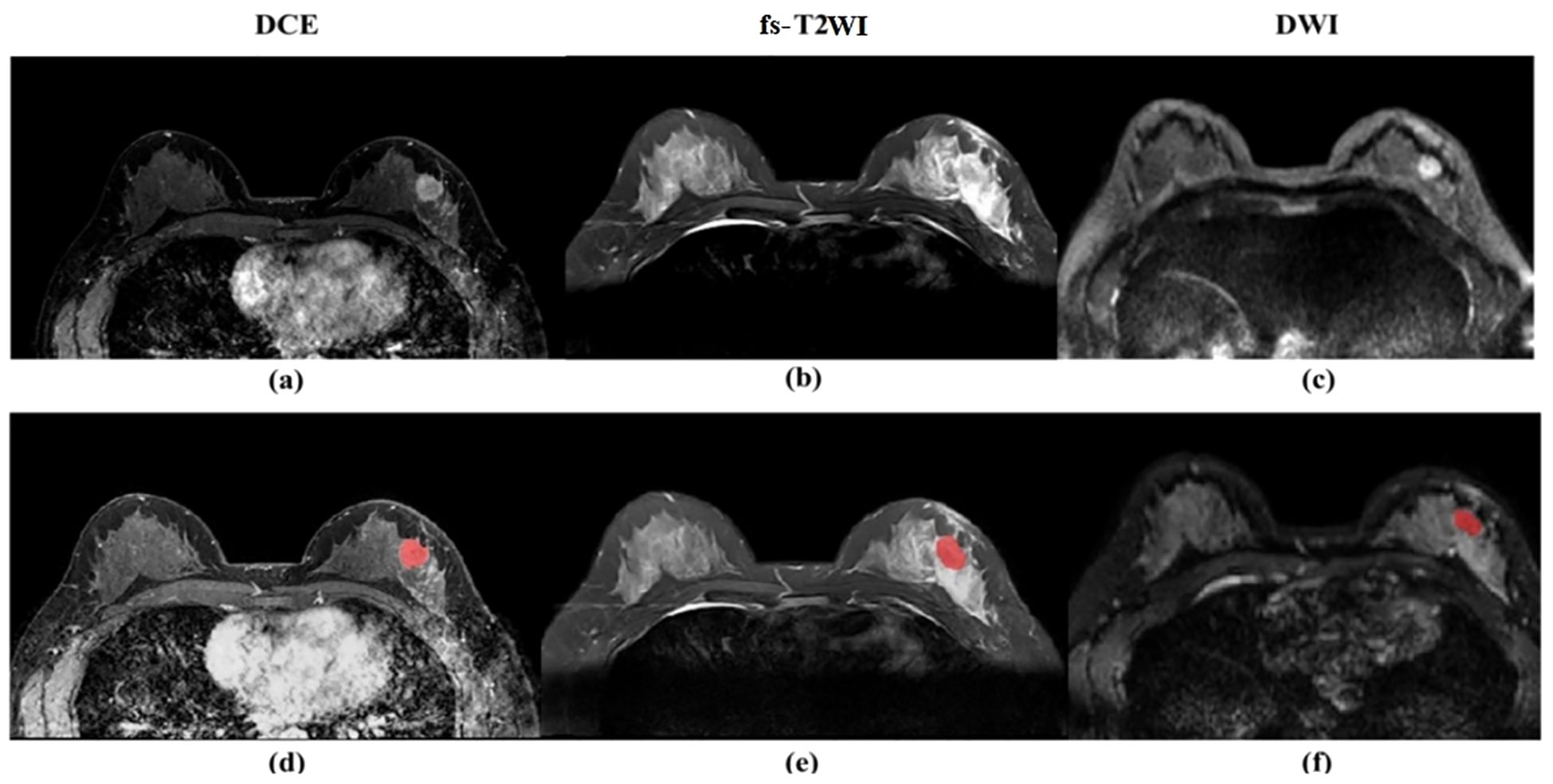 Six-panel medical imaging showing breast MRI scans. Top row: (a) DCE shows a highlighted area, (b) fs-T2WI with no highlights, (c) DWI highlighting irregular areas. Bottom row: (d) DCE, (e) fs-T2WI, and (f) DWI all have marked red areas indicating concern.