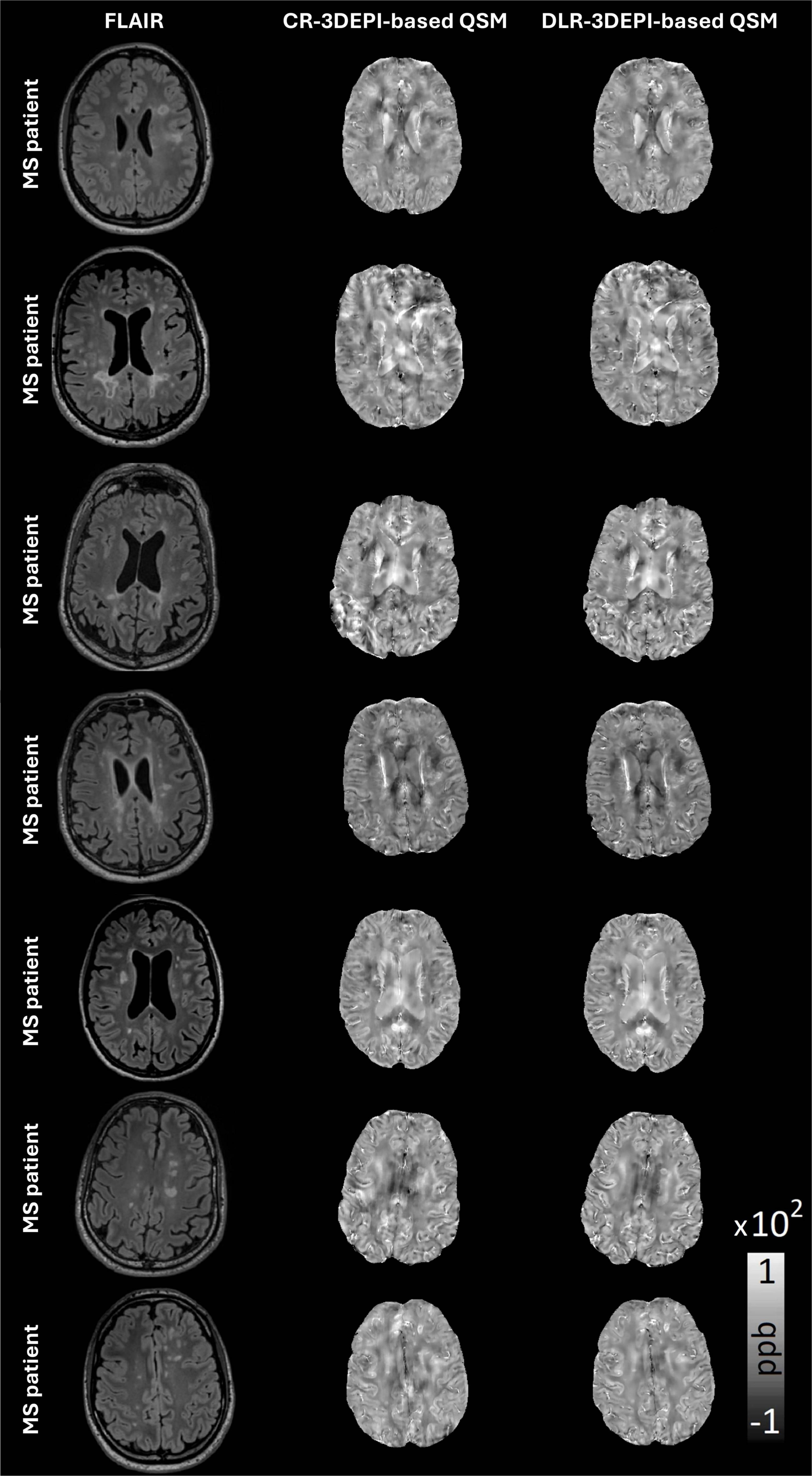 MRI images of a multiple sclerosis patient are displayed in three columns. The first column shows FLAIR images. The second column shows CR-phase based QSM images. The third column shows DLR-phase based QSM images. Each row presents different slices of the brain for comparison.