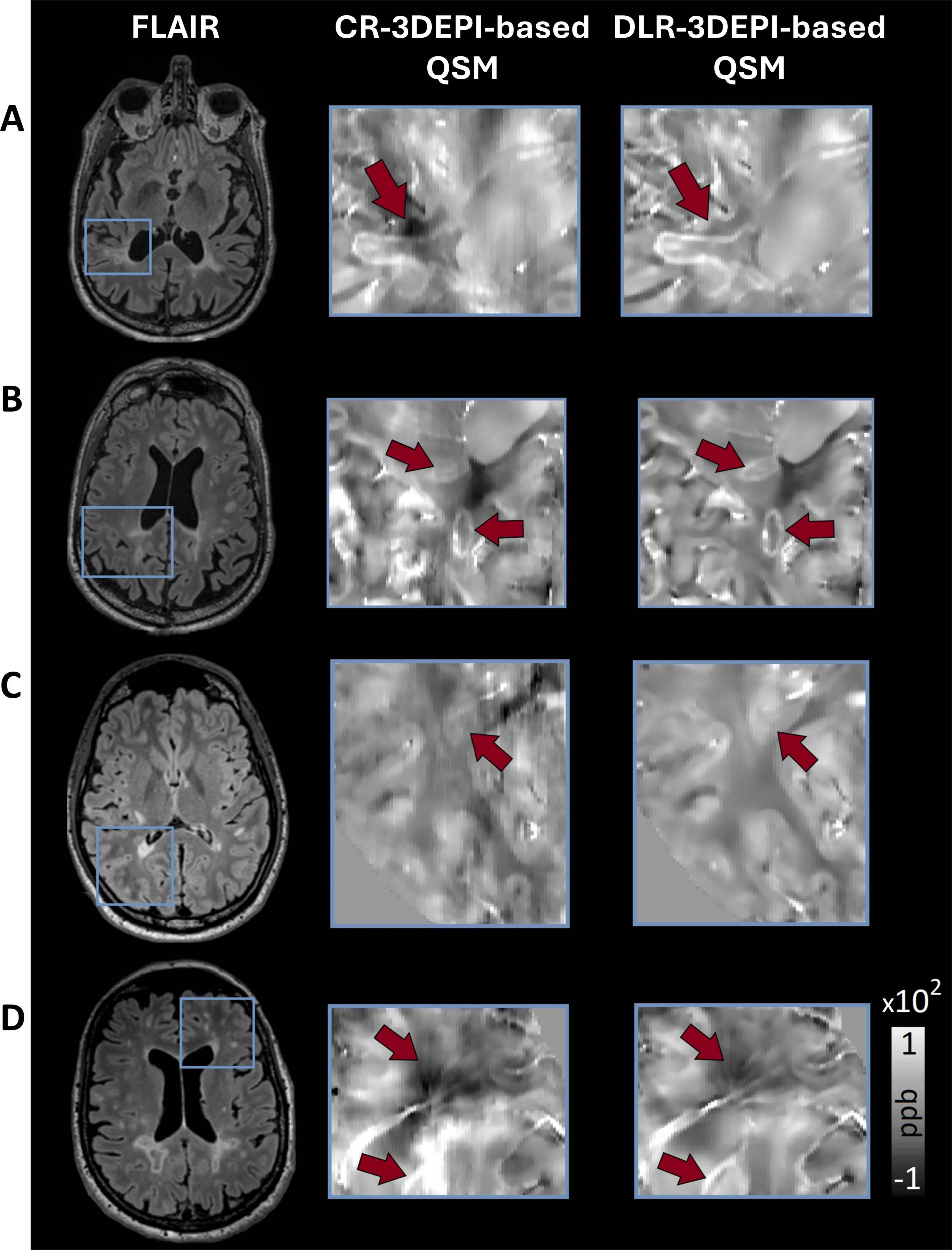 Four rows labeled A to D show brain MRI scans. Each row has three columns: FLAIR on the left, CR-Phase based QSM in the middle, and DLR-Phase based QSM on the right. Red arrows highlight specific areas in the QSM images. A scale on the right indicates units in parts per billion, ranging from negative one to positive one hundred.