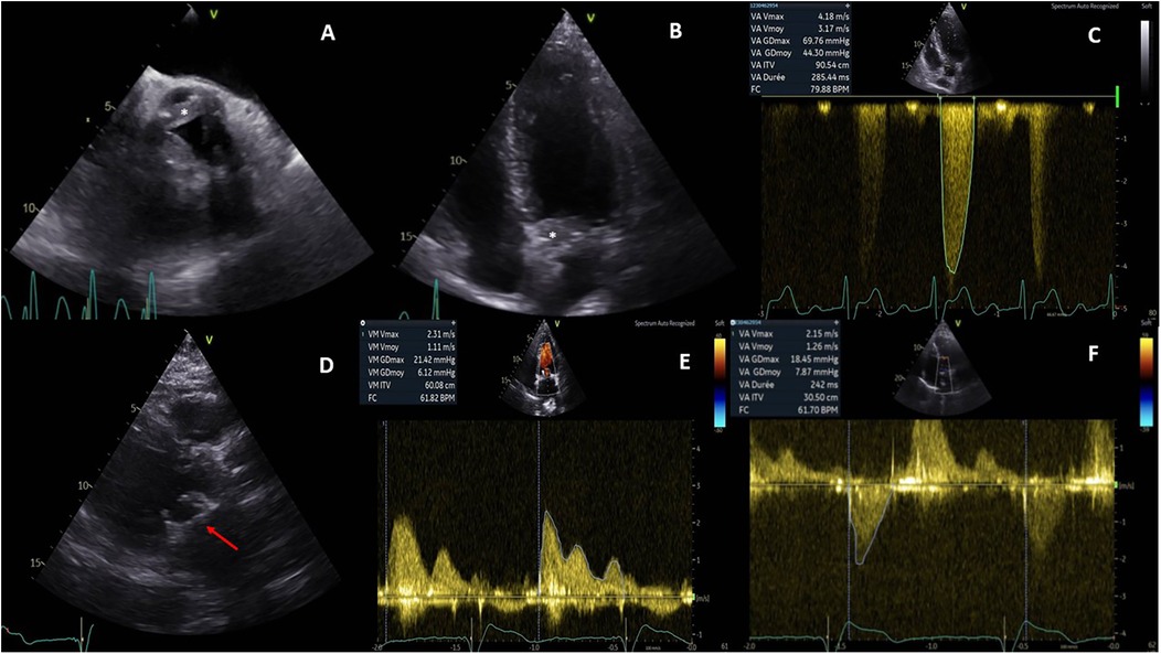 Composite of cardiac ultrasound images: Panel A shows an ultrasound with a white asterisk indicating a feature. Panel B has a similar ultrasound with another asterisk. Panel C displays a Doppler ultrasound with velocity data. Panel D shows another ultrasound with a red arrow. Panel E depicts a color Doppler image. Panel F illustrates another Doppler ultrasound with measurements. The Doppler images show velocity waveforms and include data such as peak velocities and heart rate.