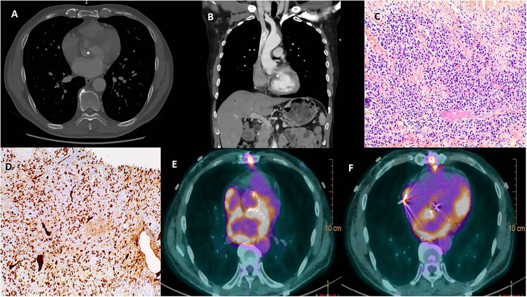 Six-panel medical image showing various diagnostic views: A and B depict axial and coronal CT scans with a highlighted area, C is a histological image showing dense cellularity, D shows immunohistochemistry with positive staining, and E and F are PET-CT scans illustrating metabolic activity in the thoracic region.