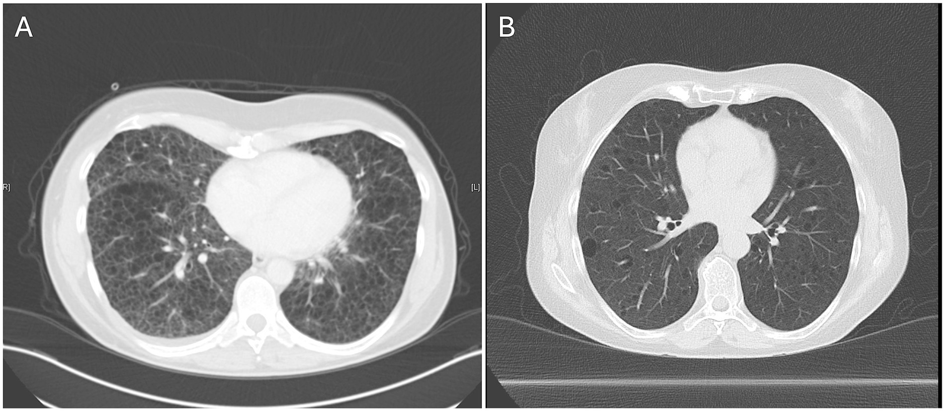 CT scan images of a chest showing lung sections. Image A appears to show a denser, potentially abnormal pattern compared to Image B, which looks clearer. Both images focus on lung and heart areas.