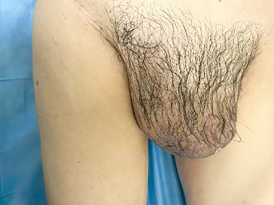 A skin area on a person's body, likely a flap, covered with dark hair resting against bare skin. The background is a light blue cloth, suggesting a medical setting.