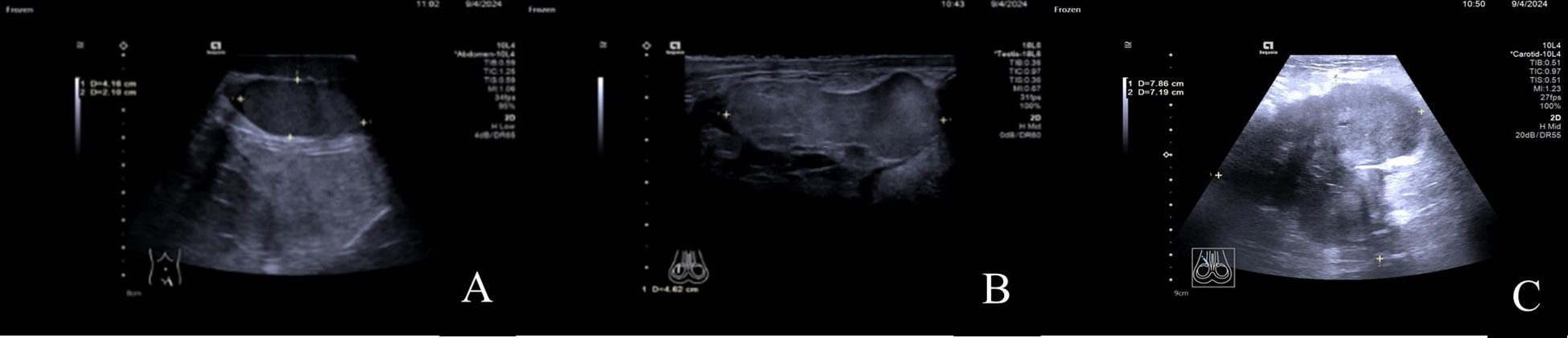 Three ultrasound images labeled A, B, and C. Image A shows a transverse view with measurements overlaying the image. Image B displays a longitudinal view with similar measurements. Image C presents another view, also with measurement labels. The images include ultrasound settings and icons.