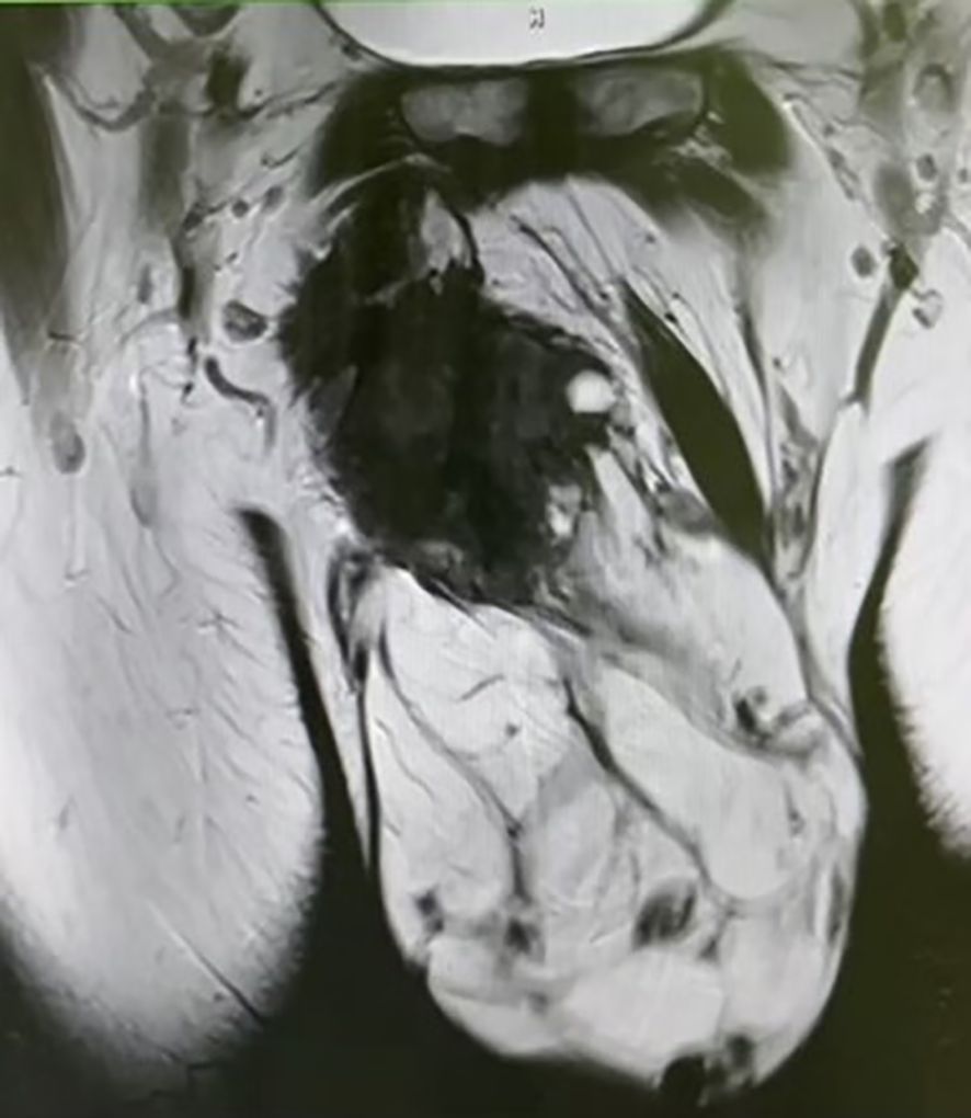MRI scan showing a cross-sectional view of the pelvic region. Varied shades of gray depict different tissues, with a central dark area potentially indicating an abnormality.