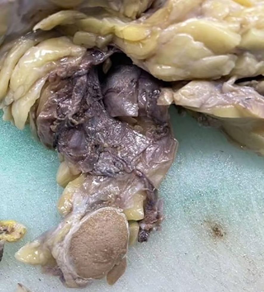 Close-up of a dissected anatomical specimen showing fatty tissue and muscle on a cutting surface. The textures and colors vary, with some areas appearing yellow and others grayish-brown.