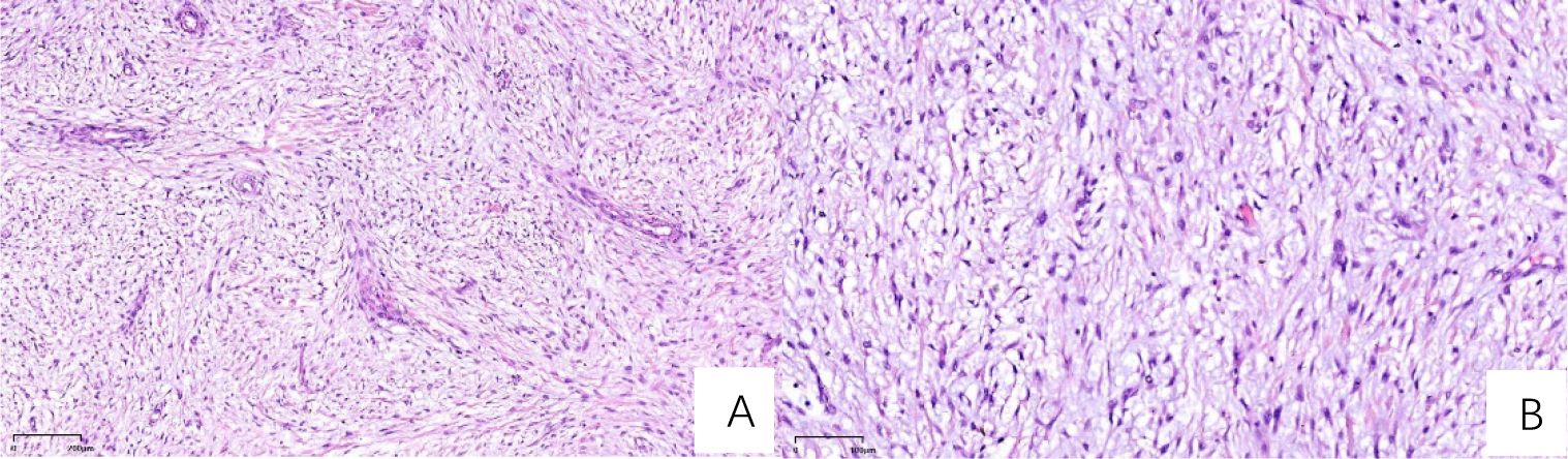 Microscopic images show two panels labeled A and B, displaying tissue sections stained in shades of pink and purple. Both images reveal a dense distribution of elongated cells and fibrous structures, indicating connective tissue. Panel B appears to have a slightly denser cellular arrangement than panel A.