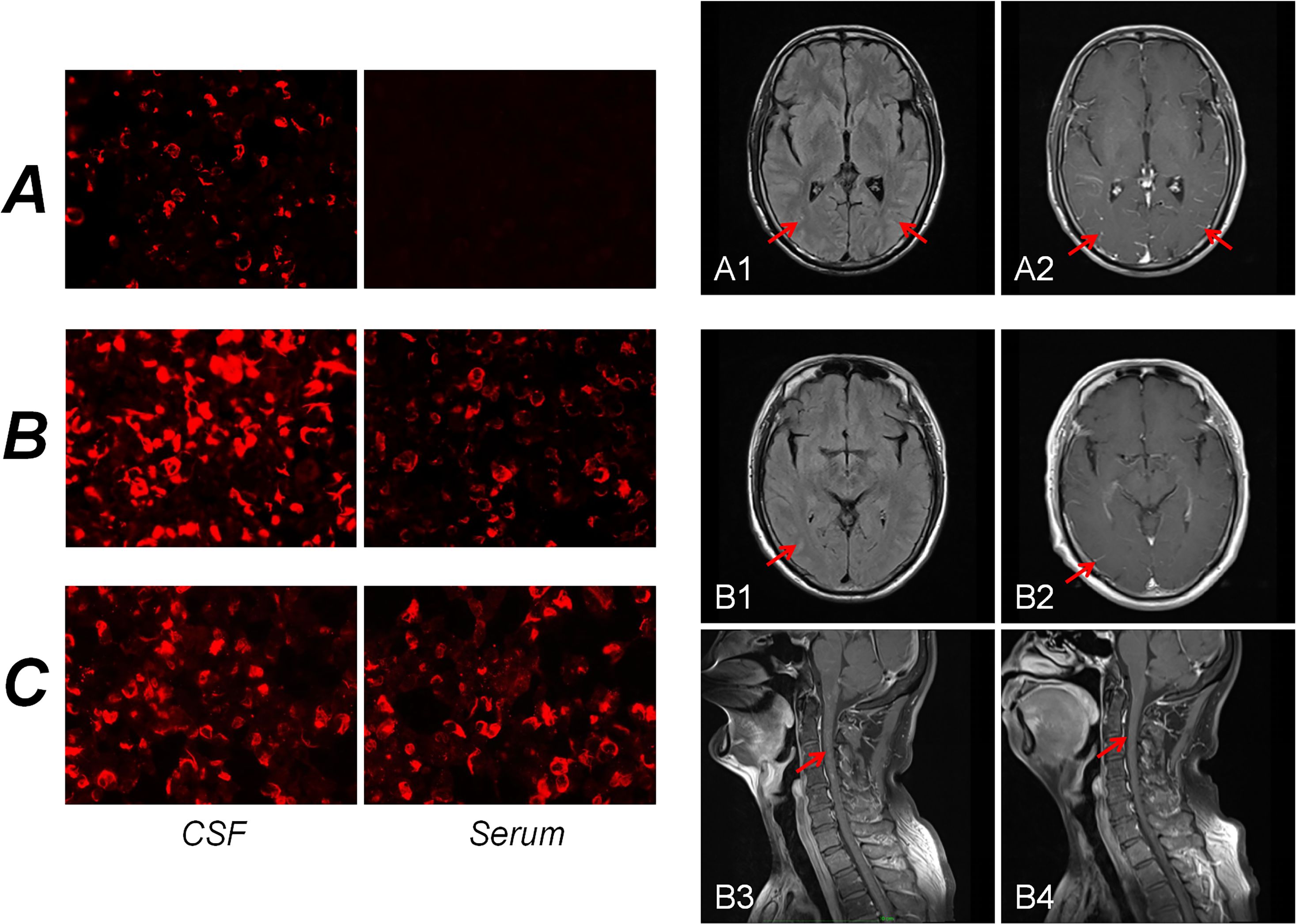 Three panels of microscopic and MRI images. Panel A shows indistinct red-stained cells, with corresponding MRI scans labeled A1 and A2 depicting brain images with red arrows indicating specific areas. Panel B displays more defined red-stained cells, with MRIs labeled B1 and B2 highlighting the brain with red arrows, and B3 and B4 focusing on the neck region. Panel C presents dense red-stained cells, labeled as CSF and Serum. Each MRI features red arrows pinpointing areas of interest.