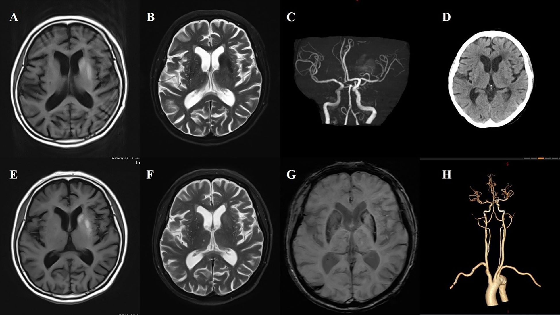 MRI and CT images of the brain depict various axial views and vascular structures. Panels A and E show T1-weighted images; B and F display T2-weighted images. Panel C and H are CT and MR angiography images highlighting cerebral blood vessels. Panel D is a CT scan, and G is a gradient echo image. Each image provides a different perspective on brain anatomy and vasculature.