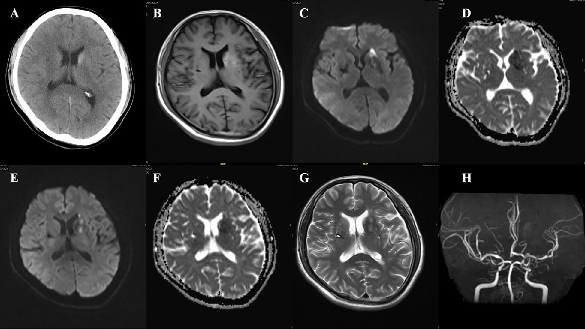 Eight medical brain scans labeled A to H. A: CT scan showing cross-section of the brain. B: MRI image with visible brain structures. C, E: Various diffusion-weighted images showing different brain areas. D, F: Apparent diffusion coefficient map. G: T2-weighted MRI image displaying detailed brain anatomy. H: Magnetic resonance angiography illustrating blood vessels in the brain.
