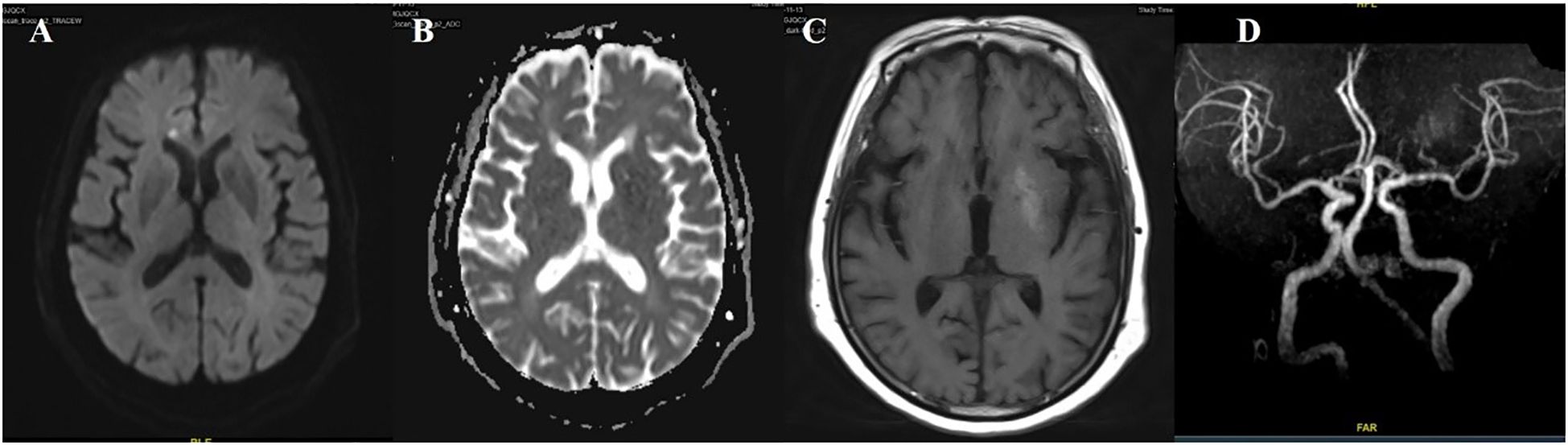 MRI scans labeled A to D. A) Diffusion-weighted imaging showing a bright area indicating potential acute ischemia. B) Apparent diffusion coefficient map showing corresponding dark area. C) T1-weighted image with increased signal intensity. D) Magnetic resonance angiography showing the cerebral arterial circulation.