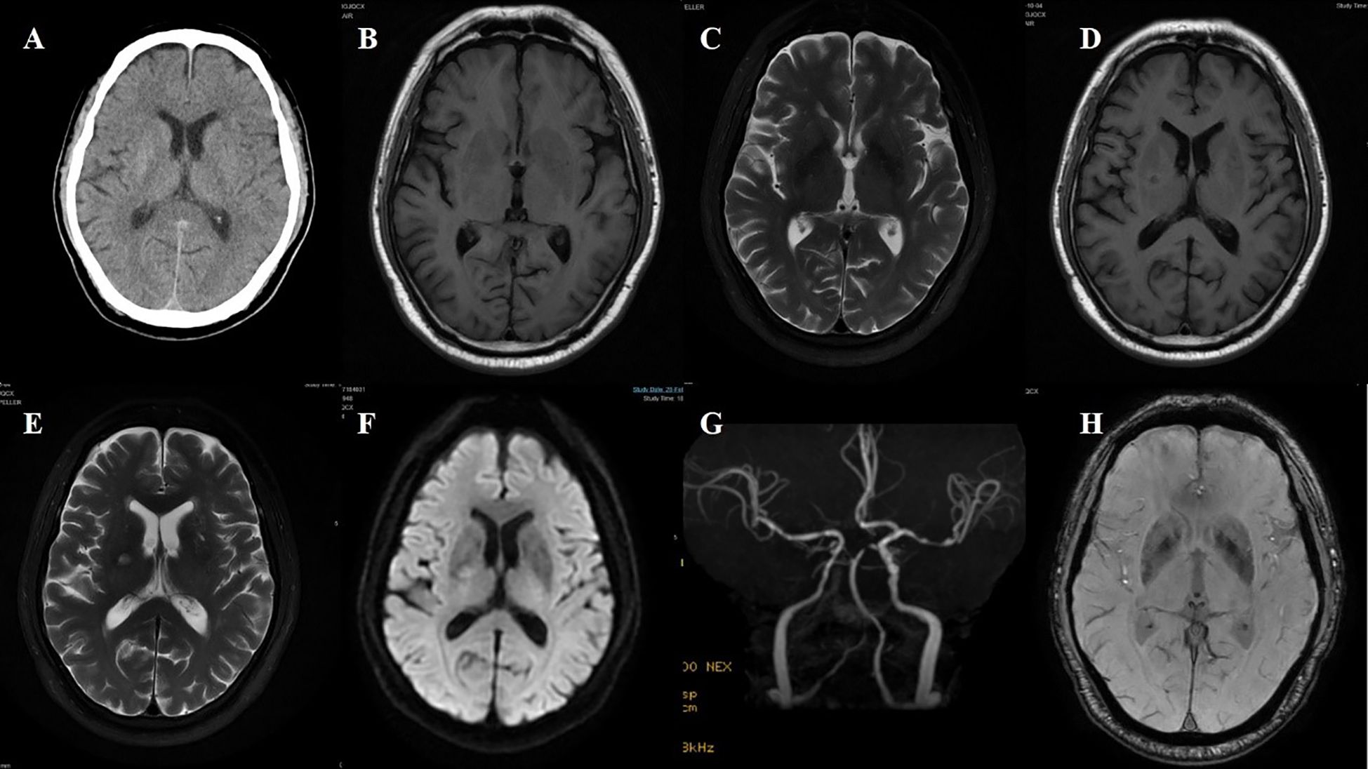 A series of brain scans labeled A–H. Panel A is a CT scan showing a slightly hyperdense lesion. Panels B, C, D, E, F, and H are brain MRIs in different sequences that do not clearly demonstrate the lesion. Panel G is an MR angiogram displaying the cerebral vasculature. Each scan provides a different perspective on the characteristics of the lesion.