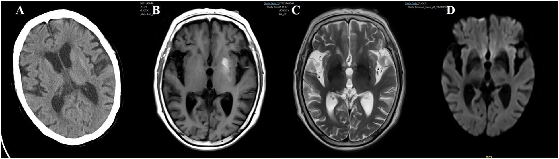 Four-panel brain imaging: A) CT scan showing brain structures. B) T1-weighted MRI displaying finer detail of brain tissue. C) T2-weighted MRI highlighting fluid-filled areas. D) Diffusion-weighted MRI. Each image provides different diagnostic insights.