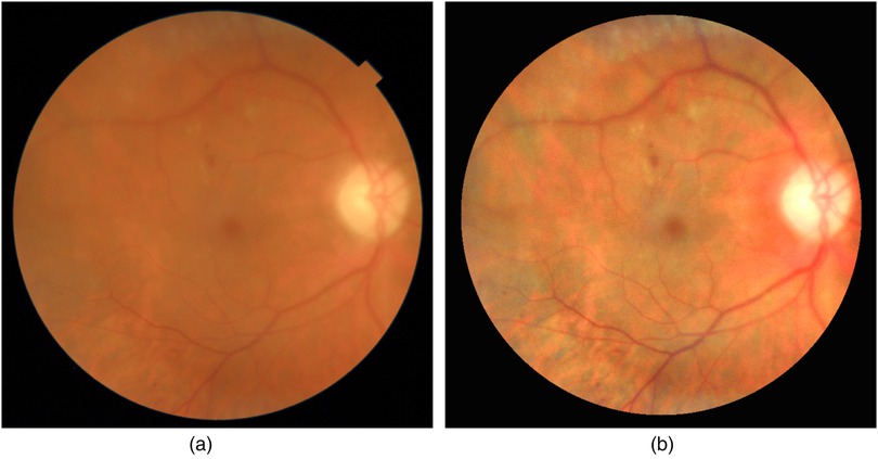 Two retinal images showing the interior surface of the eye. Image (a) displays a slightly blurred optic disc with visible blood vessels. Image (b) also shows the optic disc with more pronounced blood vessels and a clearer retinal surface.