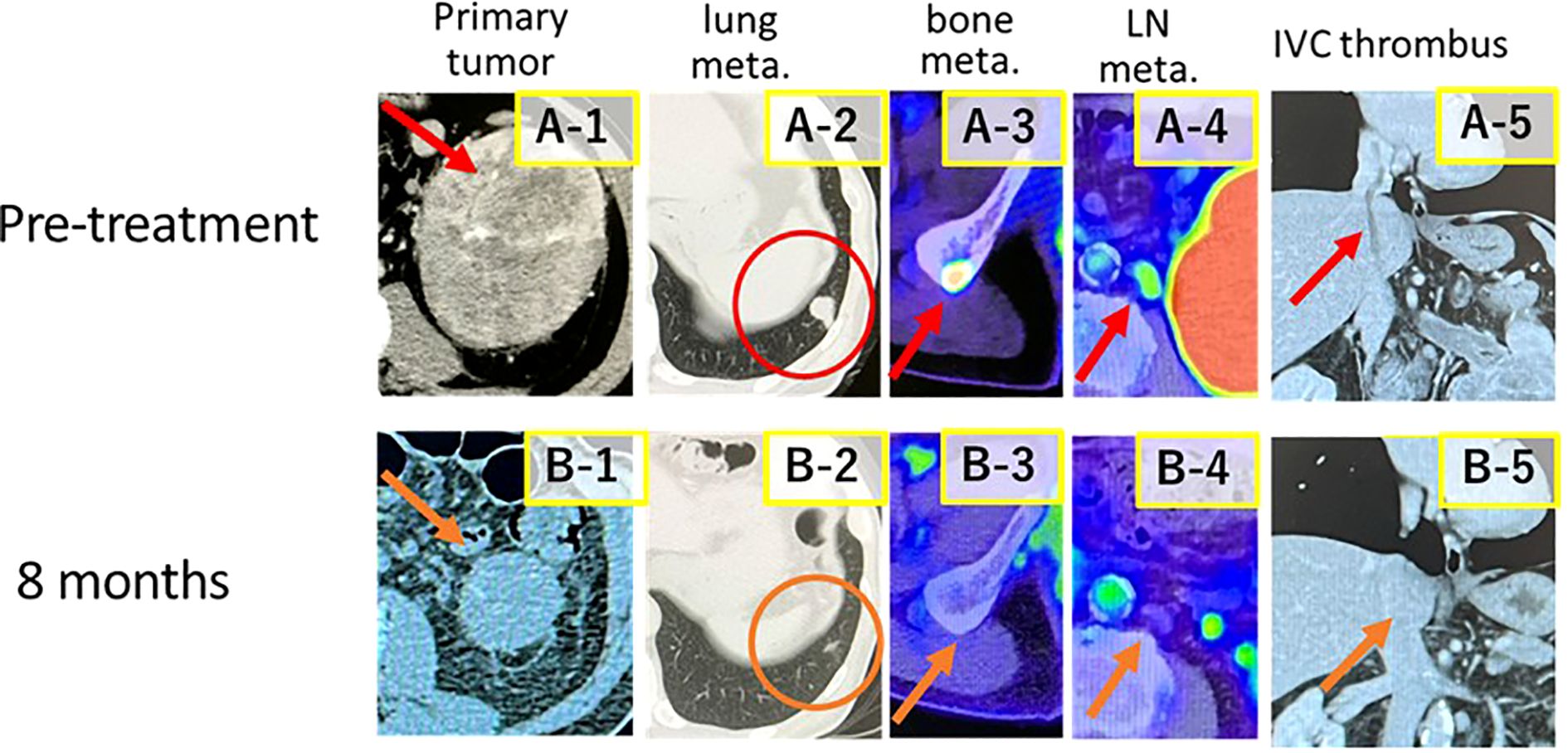 Medical imaging comparison showing changes in tumor and metastases pre-treatment and after eight months. The top row (A-1 to A-5) depicts various metastases and IVC thrombus before treatment. The bottom row (B-1 to B-5) shows the same areas after treatment, with noticeable reduction in size and presence indicated by arrows and circles.