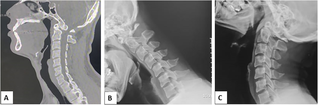 Three side-by-side medical images of the cervical spine. Image A is a CT scan showing detailed bone structure. Image B is an X-ray with improved contrast, highlighting vertebrae. Image C is a darker X-ray showing alignment.