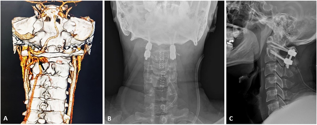 Three medical images showing the neck and cervical spine: Image A is a 3D rendering highlighting vascular structures. Image B is a frontal X-ray depicting vertebrae alignment. Image C is a lateral X-ray showing surgical screws in the cervical spine.