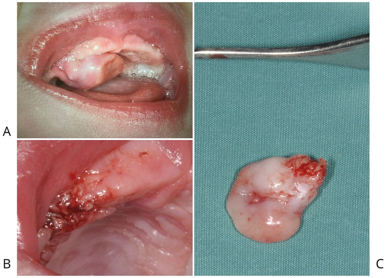 A three-panel image shows: (A) An oral cavity with a visible lesion on the upper palate. (B) A close-up of the lesion with more detail of its texture and redness. (C) The excised lesion placed on a blue surface, showing its size and appearance.
