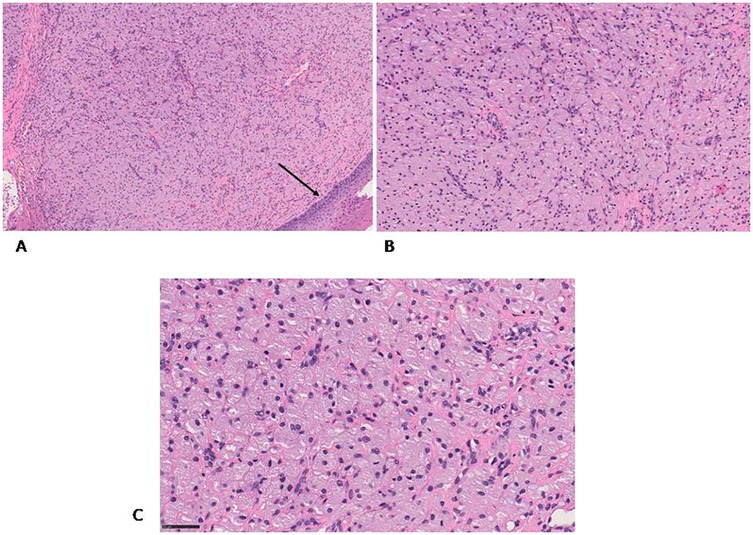 Three histopathological images labeled A, B, and C show tissue samples. A shows a large section with a dense tissue area, indicated by an arrow. B presents a magnified view with dispersed cell distribution. C shows a further magnified view with individual cells and nuclei clearly visible. All images are stained for microscopic examination.