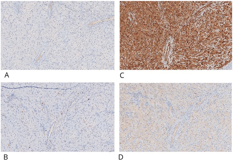Histological images labeled A, B, C, and D. Image A and B show light staining with sparse blue irregular patterns on a pale background. Image C displays dense, dark brown staining with prominent texture. Image D shows light staining with blue and pale pink hues.