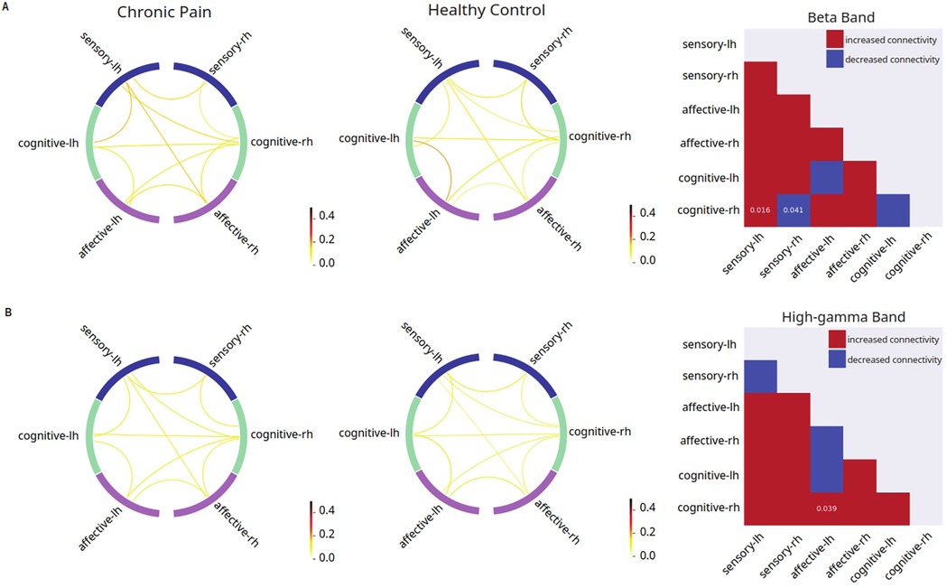 Panel (A) shows beta band connectivity patterns in chronic pain and healthy control groups, with circular plots illustrating interconnections among sensory, affective, and cognitive brain regions in both hemispheres. The adjacent matrix highlights significant increases and decreases in connectivity between region pairs, with p-values indicating statistical significance. Panel (B) presents similar plots for high-gamma band connectivity, again comparing chronic pain and control groups. Rightmost matrices show group differences, with red indicating increased and blue indicating decreased connectivity in chronic pain, emphasizing altered neural communication patterns in both frequency bands.