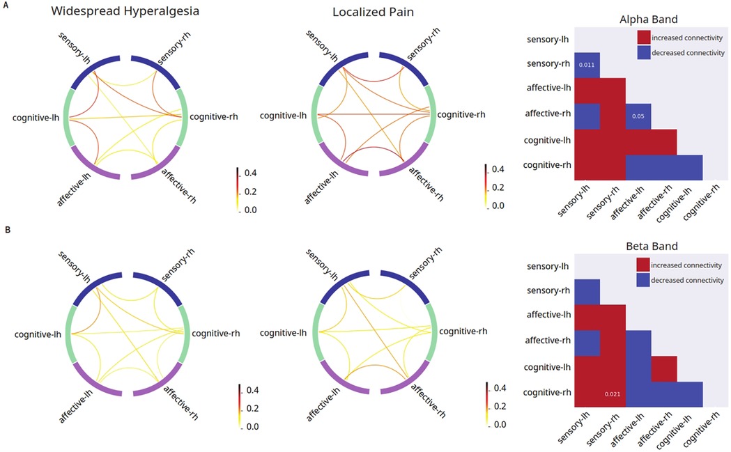 Panel A compares alpha band connectivity patterns in widespread hyperalgesia and localized pain groups, with circular plots illustrating interconnections among sensory, affective, and cognitive brain regions in hemispheres. The adjacent matrix highlights significant increases and decreases in connectivity between region pairs, with p-values indicat-ing statistical significance. Panel B presents similar plots for beta band connectivity, again comparing widespread hyperalgesia and localized pain groups. Rightmost matrices show group differences, with red indicating increased and blue indicating decreased connectivity in chronic pain, emphasizing altered neural communication patterns in both frequency bands.