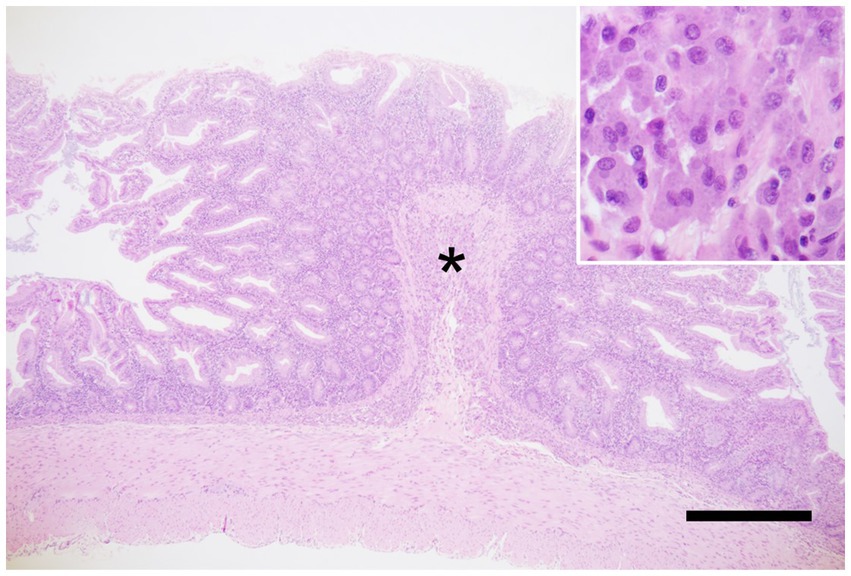 Histological image of the ileum from a marmoset with marmoset wasting syndrome (MWS), stained with hematoxylin and eosin. Moderate infiltration of lymphocytes and plasma cells is visible in the lamina propria. The submucosa shows dense macrophage infiltration, marked with an asterisk. The inset in the upper right highlights macrophages with abundant cytoplasm. A scale bar is visible in the lower right corner.