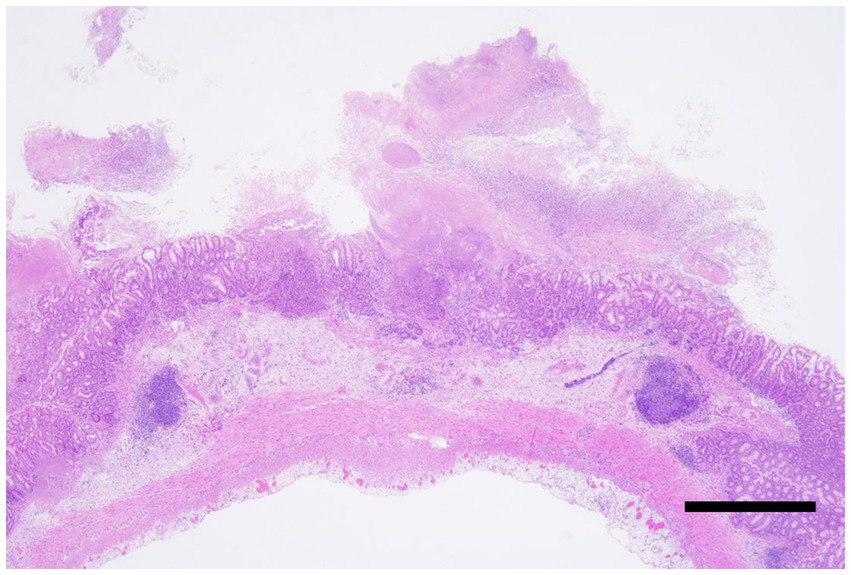 Microscopic image of the colon from a marmoset with Clostridioides difficile-associated disease (CDAD), stained with hematoxylin and eosin. A layered structure is observed, showing pseudomembranous enterocolitis with fibrin and necrotic debris across the mucosal surface. A scale bar is visible.
