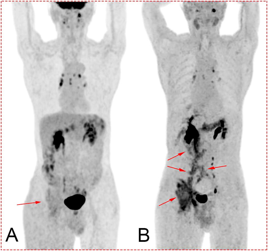 PET scan comparison showing two images labeled A and B, depicting frontal views of the human body. Image A shows a single arrow pointing to a dark area in the lower abdomen. Image B features multiple arrows highlighting several darkened regions throughout the abdomen, indicating increased uptake or activity.