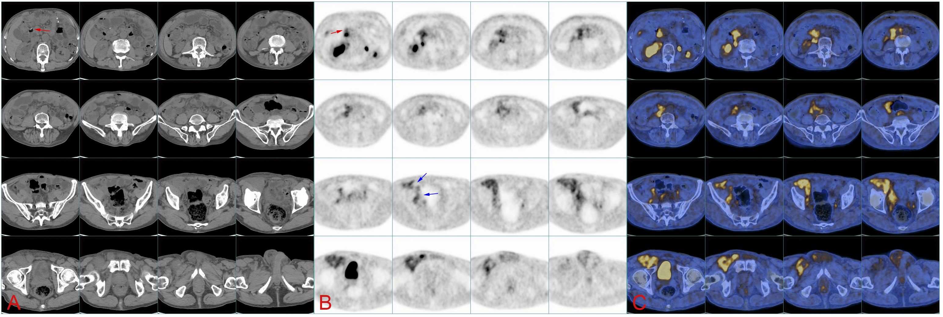 Medical imaging comparison showing three columns labeled A, B, and C. Column A contains grayscale CT scan images with a red arrow highlighting areas. Column B displays PET scan images with black and white gradations, including a blue arrow indicating certain features. Column C features combined PET-CT scans with areas highlighted in yellow and blue, representing metabolic activity and anatomical structures.