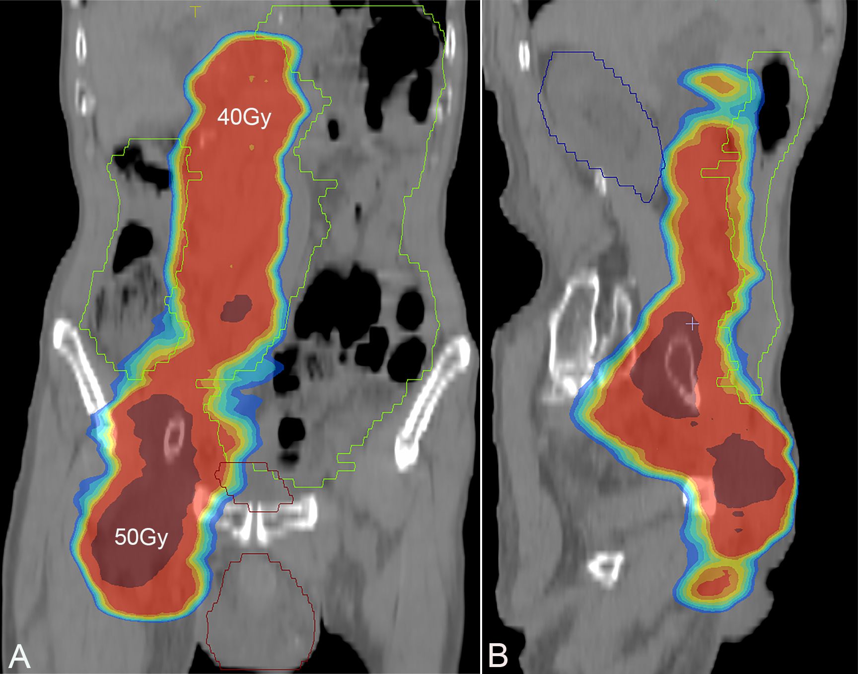 Medical imaging displays two cross-sectional scans with colored overlays indicating radiation dose distribution. Left image shows red areas with dose levels at forty Gray and fifty Gray. Right image highlights similar zones with varying contour outlines.