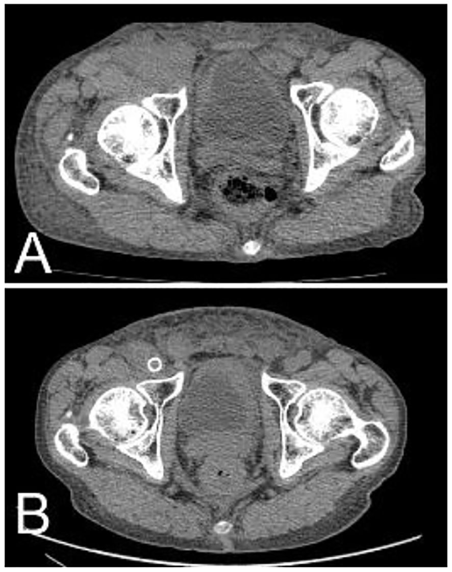 CT scan images labeled A and B show cross-sectional views of the pelvis. Both images display pelvic bones and internal structures in varying shades, indicating different tissue densities.