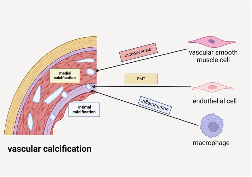 Diagram of vascular calcification showing medial and intimal calcification within a blood vessel wall. Arrows connect vascular smooth muscle cells to medial calcification via osteogenesis, endothelial cells to intimal calcification via EMT (endothelial-mesenchymal transition), and macrophages to intimal calcification via inflammation.