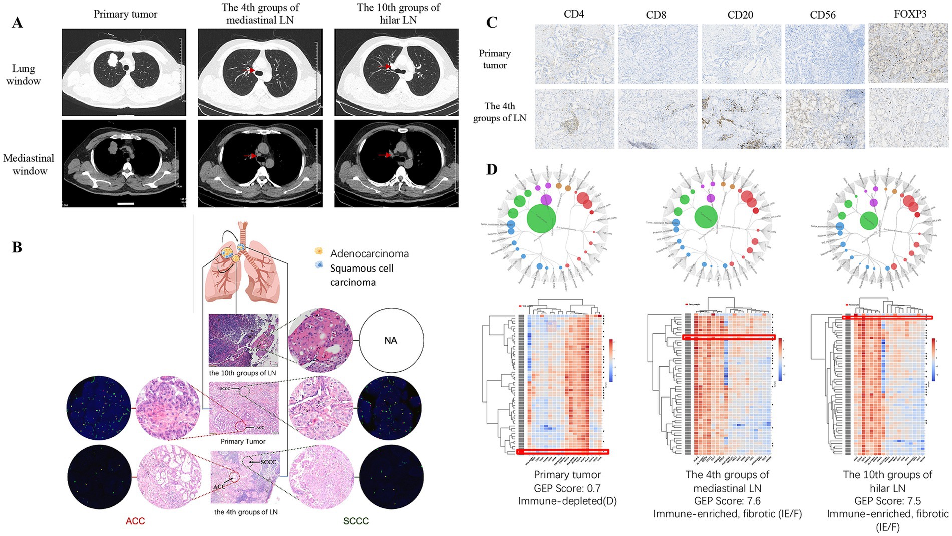 Medical images consist of four panels: A) CT scans showing primary tumor and lymph node groups with lung and mediastinal windows. B) Diagram illustrating lung cancer and histological images of adenocarcinoma and squamous cell carcinoma. C) Immunohistochemical staining for markers CD4, CD8, CD20, CD56, and FOXP3 compared between primary tumor and lymph nodes. D) Gene expression profiles depicted with circular diagrams and heatmaps for primary tumor and lymph nodes, showing varying immune status and GEP scores.