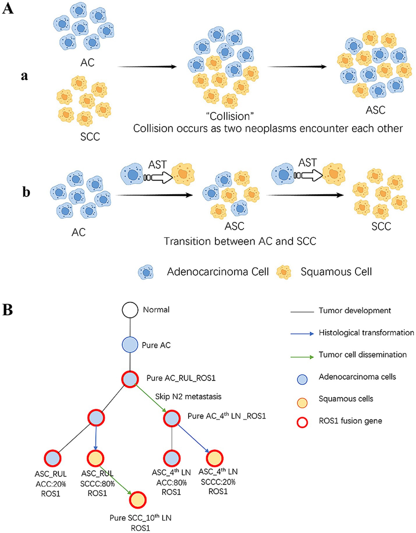 Diagram illustrating cancer cell interactions and progression. Panel A shows two scenarios: a) Collision model where adenocarcinoma (AC) and squamous cell carcinoma (SCC) encounter and merge into adenosquamous carcinoma (ASC). b) Transition model depicting AC transforming into ASC and then SCC. Panel B presents a flowchart of tumor development and transformation of our case. It outlines the progression from normal cells to pure AC and subsequent transitions involving ROS1 fusion genes. Color codes represent different cell types: blue for AC, orange for SCC, and red outlines for ROS1 fusion occurrences. Arrows indicate pathways of tumor development, histological transformation, and dissemination.