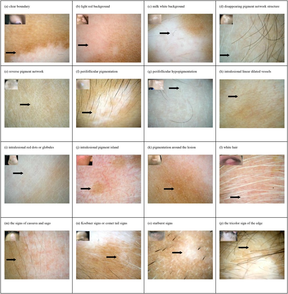 Panel images showing various skin conditions under magnification. Each image highlights specific characteristics: (a) clear boundary, (b) light red background, (c) milky white background, (d) disappearing pigment network, (e) reverse pigment network, (f) perifollicular pigmentation, (g) perifollicular hypopigmentation, (h) intralesional linear dilated vessels, (i) intralesional red dots, (j) intralesional pigment island, (k) pigmentation around the lesion, (l) white hair, (m) cassava and sago signs, (n) Koebner signs or comet tail signs, (o) starburst signs, (p) tricolor sign at the edge. Each section includes arrows pointing to the highlighted features.