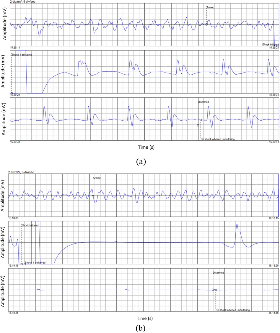 Graph (a) shows three ECG strips with amplitude in millivolts over time. The first strip shows an erratic pattern, an \