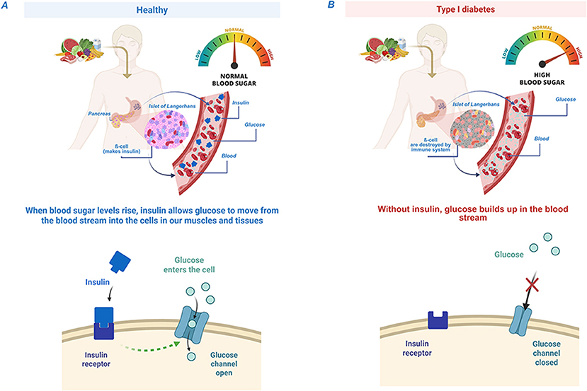 Illustration comparing healthy glucose regulation and Type 1 diabetes. Panel A shows normal insulin function enabling glucose entry into cells, maintaining normal blood sugar. Panel B depicts Type 1 diabetes, where damaged beta cells prevent insulin production, leading to high blood sugar as glucose accumulates in the bloodstream. Both panels include diagrams of insulin interaction with receptors and a glucose channel.