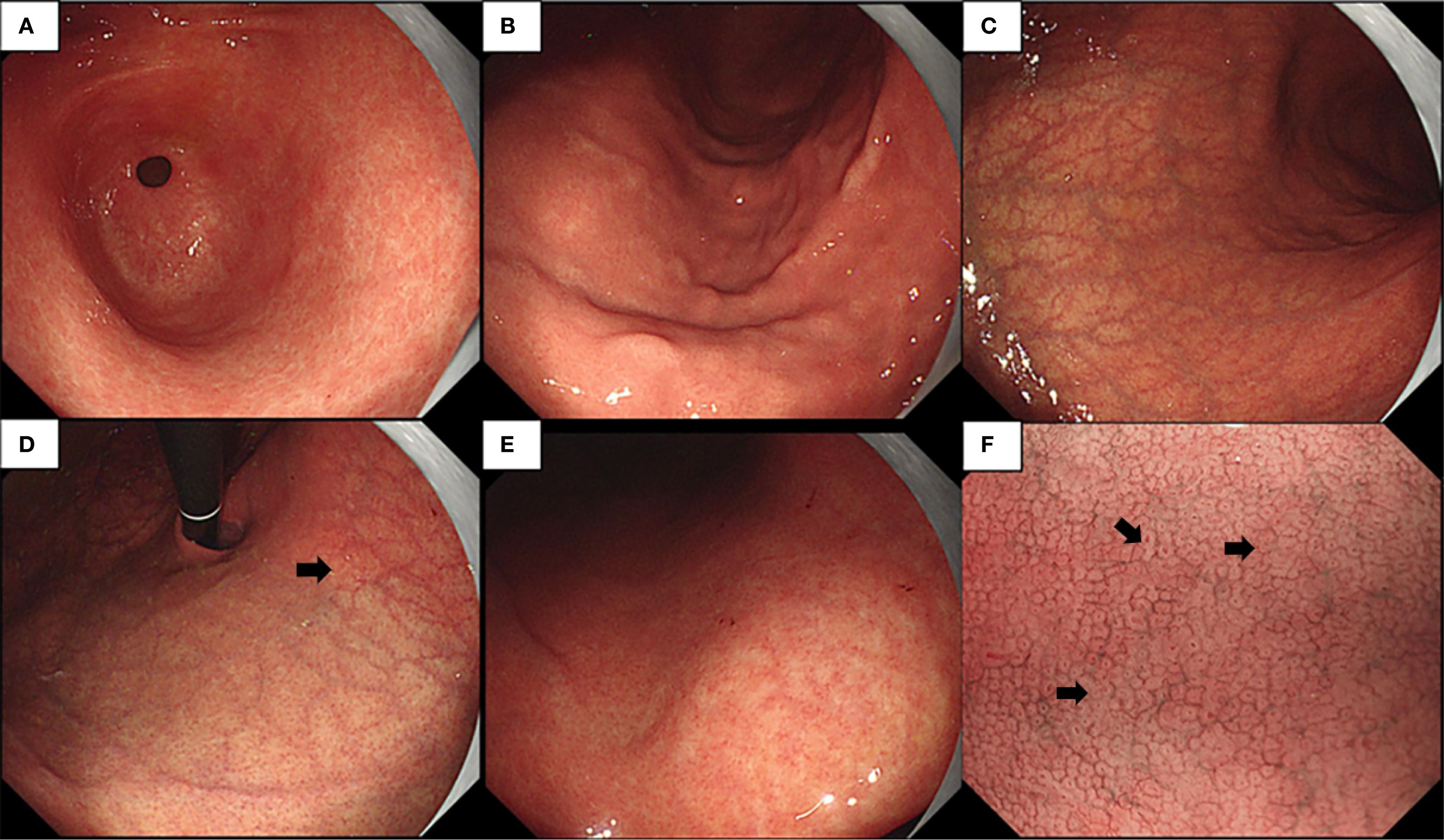 Endoscopic images showing various views of the gastrointestinal tract. Panel A shows a circular view of the esophagus. Panel B displays a slightly constricted area. Panel C shows a broader view of the intestinal wall. Panel D includes an endoscopic instrument and a highlighted area. Panel E shows normal mucosal lining. Panel F highlights some vascular patterns with arrows indicating specific spots.