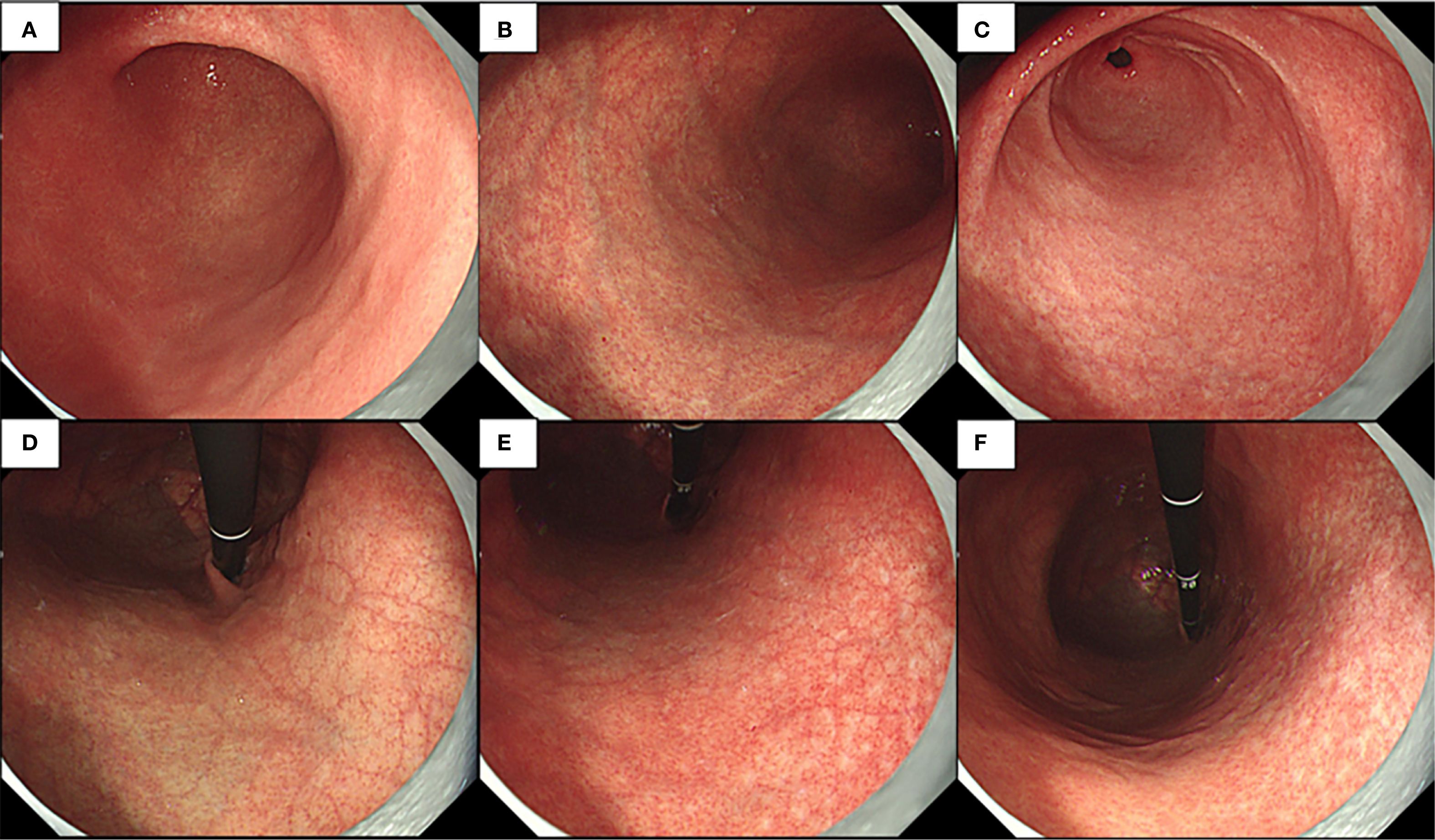 Six-paneled endoscopic images labeled A to F, showing a colonoscopy with various views of the colon lining. Panels D, E, and F depict an endoscopic instrument inside the colon. The inner lining appears smooth with a reddish hue throughout.