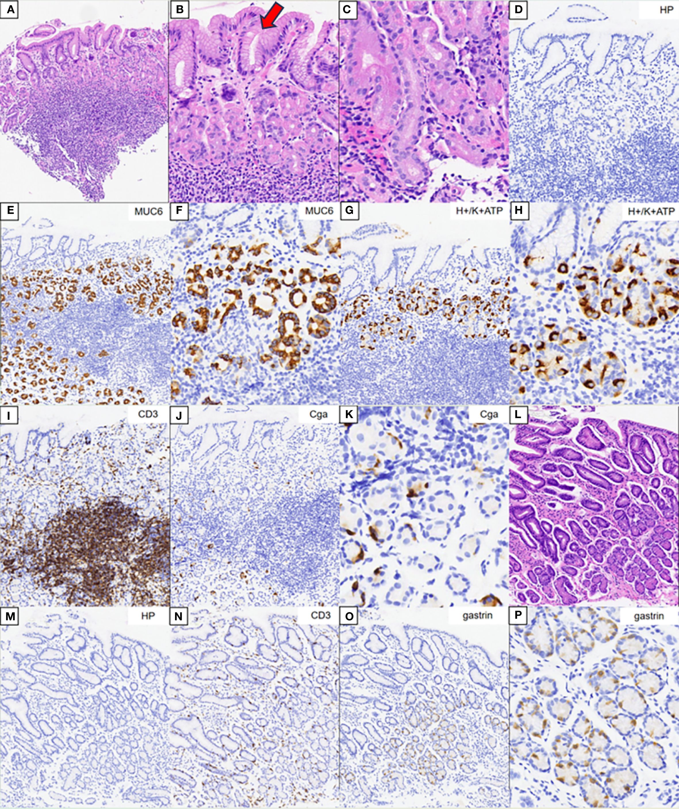 Histological images display various tissue stains. Panels A-L show hematoxylin and eosin, MUC6, H/K ATPase, CD3, and chromogranin A staining, indicating cellular structure and protein expression. Panels M-P display additional staining for helicobacter pylori, CD3, and gastrin. A range of magnifications captures glandular architecture and cellular details, with some areas highlighted by arrows.