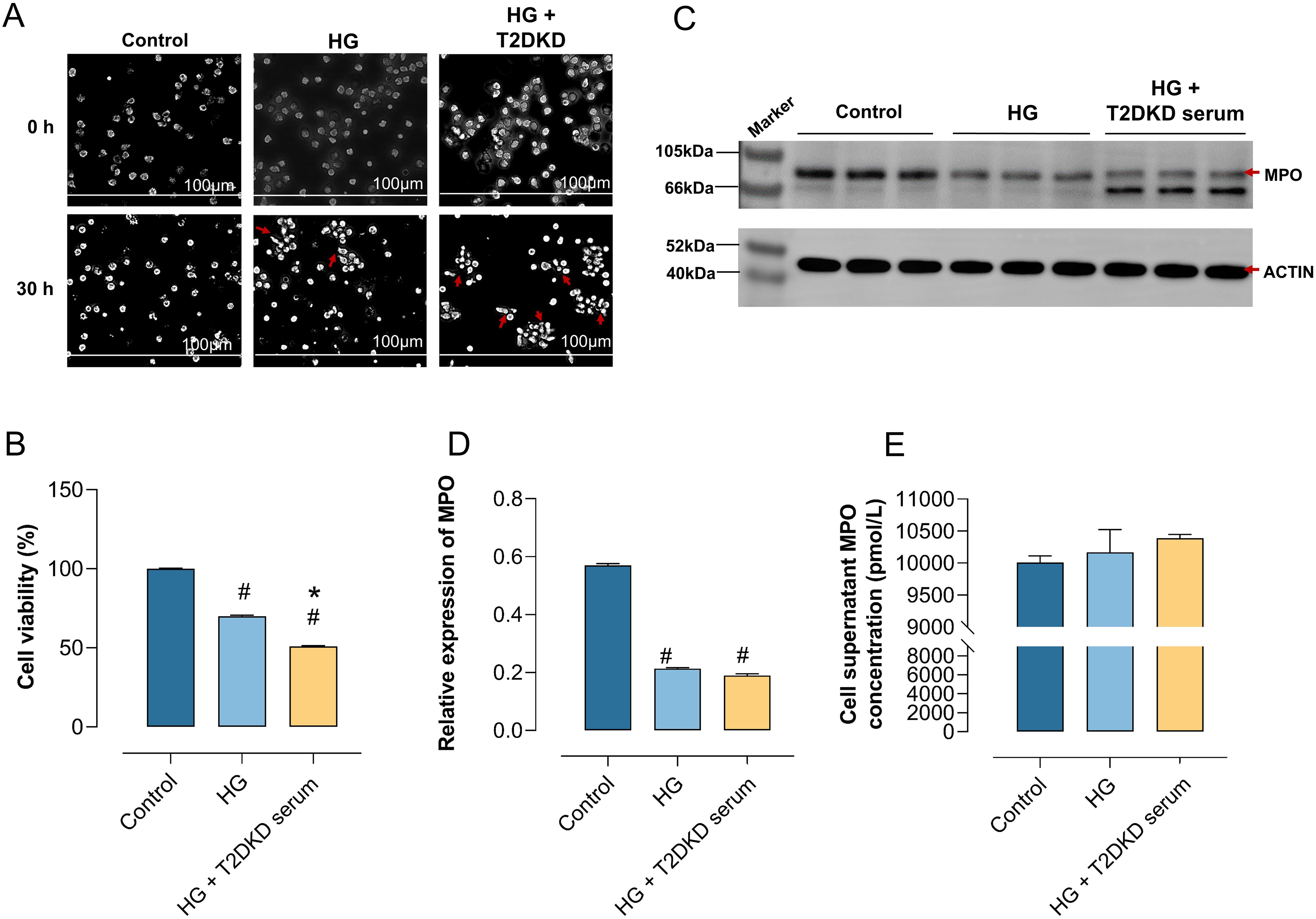Panel A shows cell images at 0 and 30 hours under control, high glucose (HG), and HG with T2DKD treatments. Panel B is a bar graph of cell viability percentage, with control highest, followed by HG and HG with T2DKD. Panel C displays a Western blot for MPO and ACTIN under the same conditions. Panel D is a bar graph of relative MPO expression, highest in control. Panel E is a bar graph of MPO concentration in cell supernatant, showing similar levels across treatments.