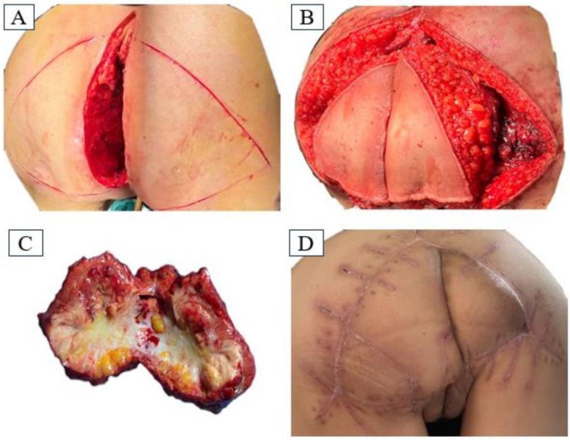 Panel A shows a large, deep incision on the buttock with surrounding markings. Panel B depicts the open surgical site revealing tissues and structures beneath the skin. Panel C displays a removed specimen showing an irregular and bloody surface. Panel D shows the post-operative result with healed surgical scars and sutures on the buttock area.